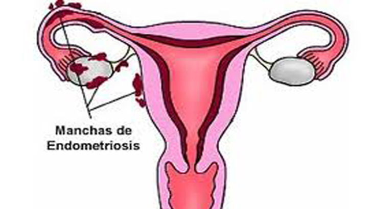 Nueva terapia para tratar la endometriosis