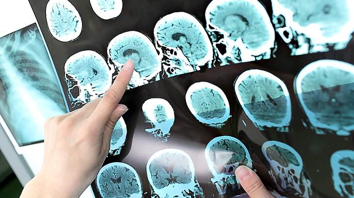 Inteligencia Artificial para detectar Alzheimer en forma temprana